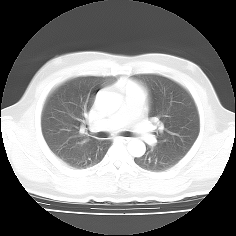 CT画像の肺野条件表示モード